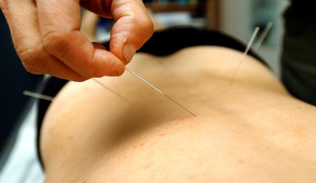 Soulagement des maux de dos par l'acupuncture