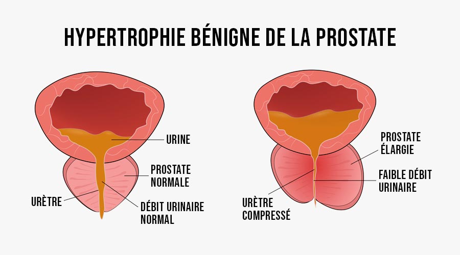 Hypertrophie bénigne de la prostate (HBP) : causes et symptômes