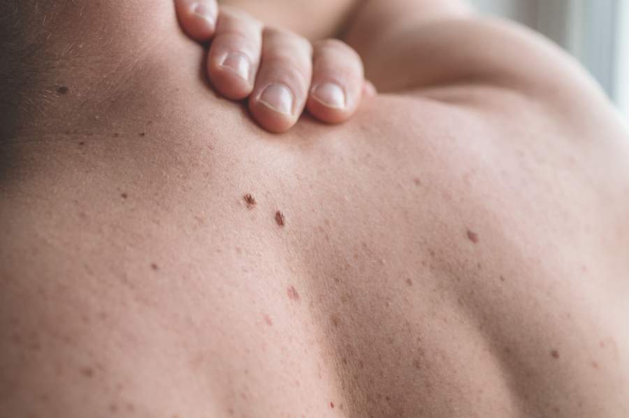 Zona et maladies chroniques : un risque méconnu chez les Canadiens de 50 ans et plus